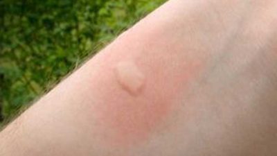 Sivrisinek ısırığı şişliği ve kaşıntısı nasıl geçer?